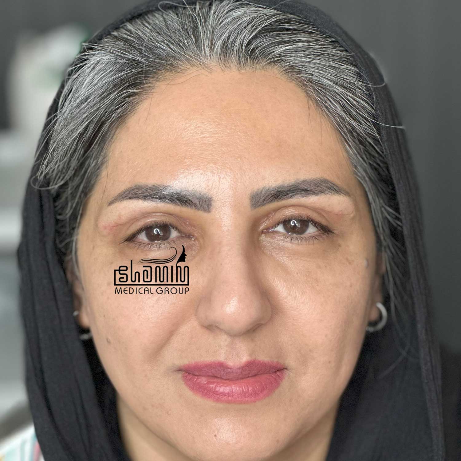 عکس بعد از بلفاروپلاستی