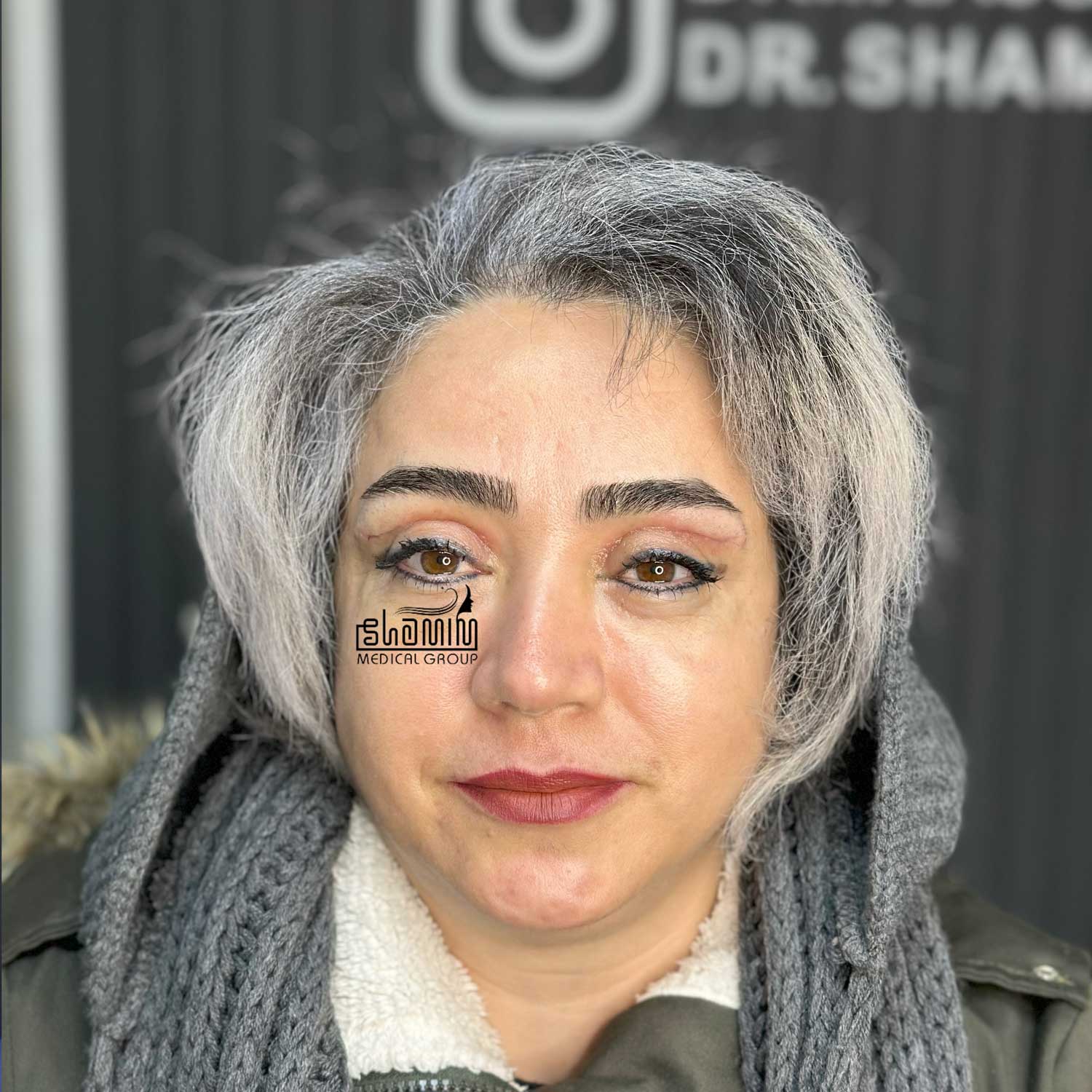 بعد - کیس ۱