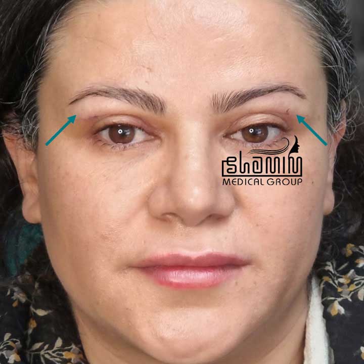 بعد - نمای کنارهم