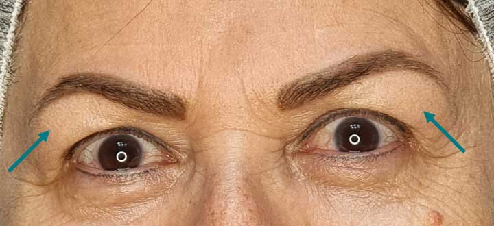 بلفاروپلاستی در کرج چیست