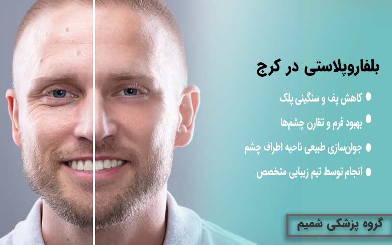 بلفاروپلاستی در کرج