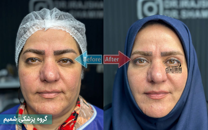 نوبت بلفاروپلاستی در کرج | بهترین جراح پلک + هزینه و مشاوره رایگان 5 نوبت بلفاروپلاستی در کرج