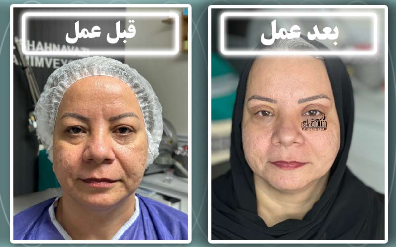 بلفاروپلاستی در کرج