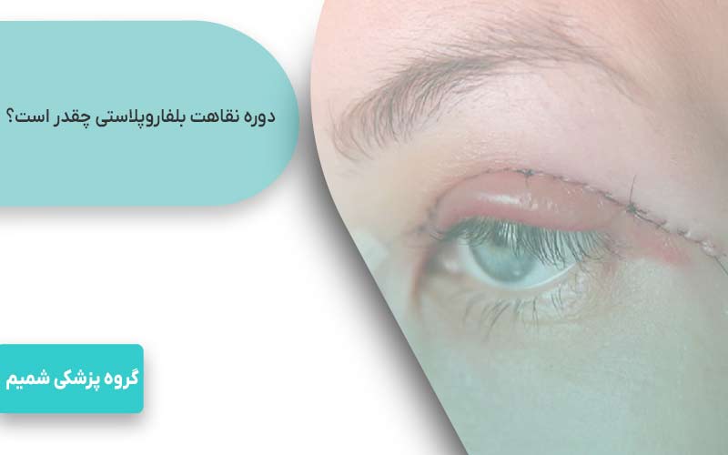  دوره نقاهت بلفاروپلاستی چقدر است؟