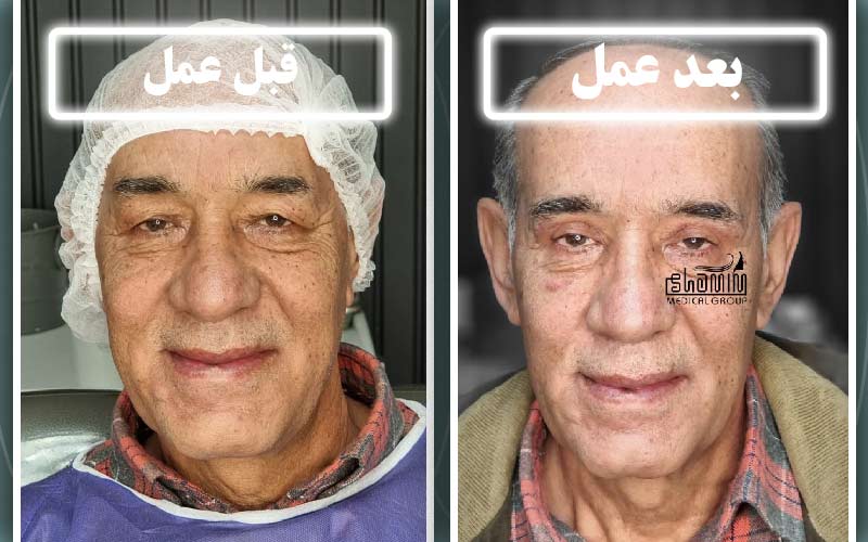 جراحی ترکیبی (پلک بالا و پایین همزمان) در کرج