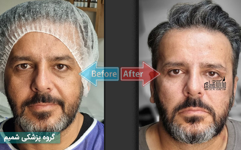 نوبت بلفاروپلاستی در کرج | بهترین جراح پلک + هزینه و مشاوره رایگان 3 ملاکهای انتخاب کلینیک معتبر بلفاروپلاستی در کرج