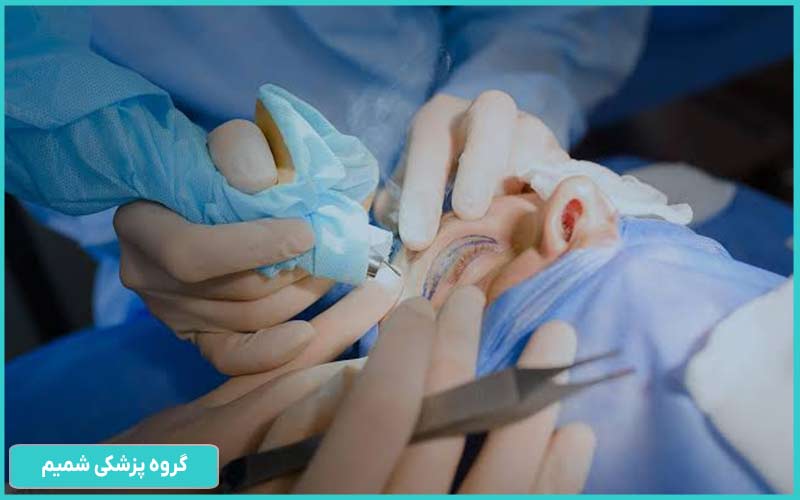بلفاروپلاستی لیزری در کرج