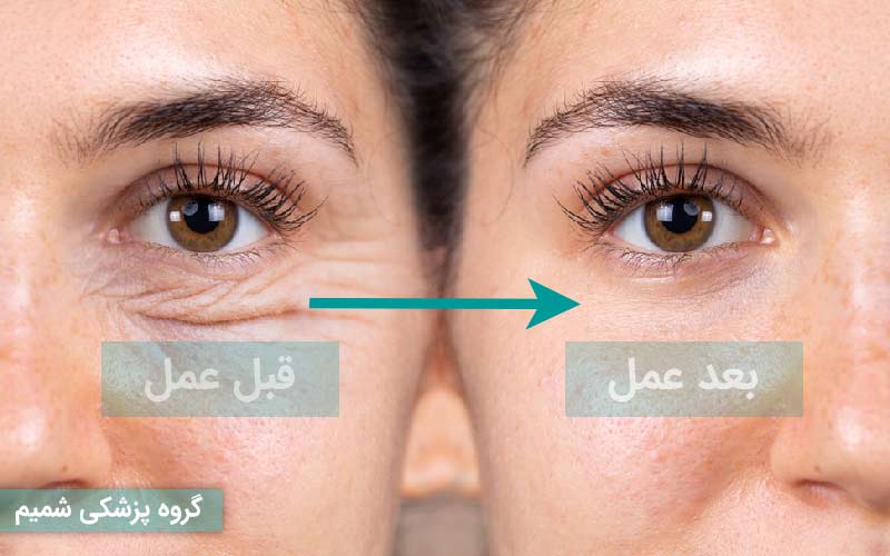 هزینه بلفاروپلاستی پلک پایین در کرج