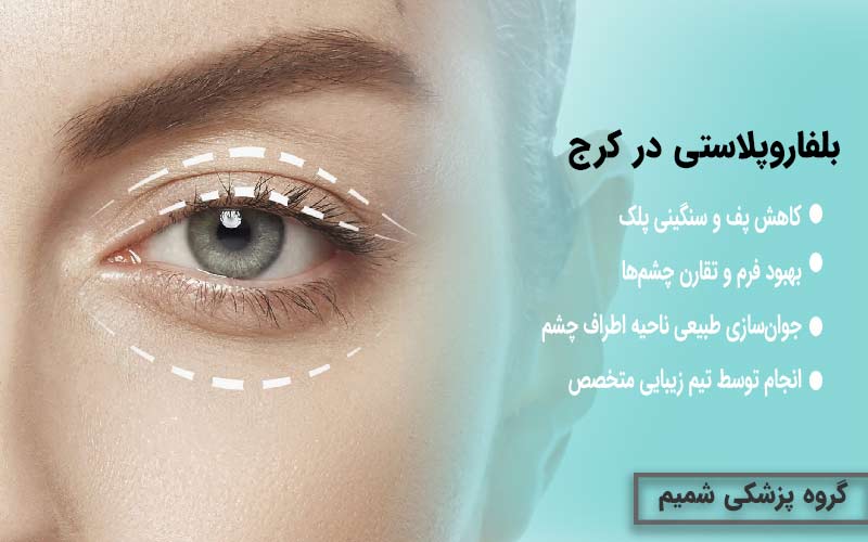 بلفاروپلاستی در کرج