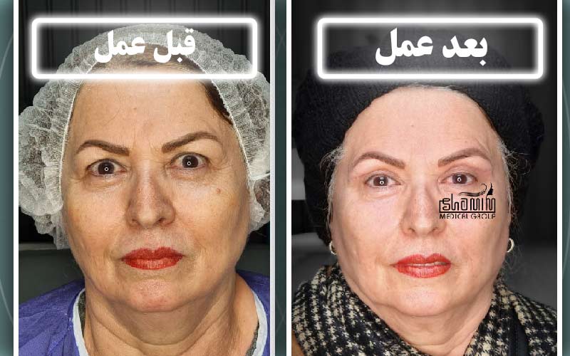 تفاوت بلفاروپلاستی پلک بالا و پلک پایین