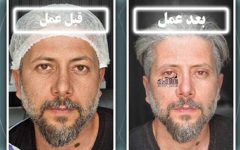 انواع روش‌های بلفاروپلاستی در کرج