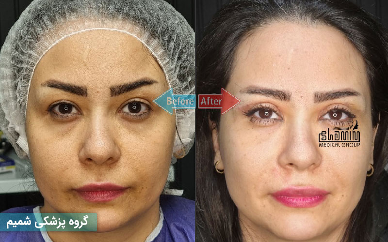 نوبت بلفاروپلاستی در کرج | بهترین جراح پلک + هزینه و مشاوره رایگان 6 چه چیزهایی در هزینه بلفاروپلاستی شامل میشود؟