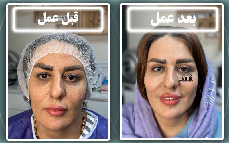 بلفاروپلاستی در کرج مناسب چه کسانی است