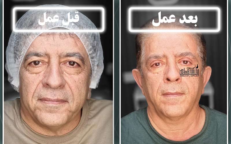 مزایای بلفاروپلاستی پلک بالا