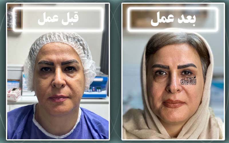 بلفاروپلاستی پلک بالا در کرج چیست