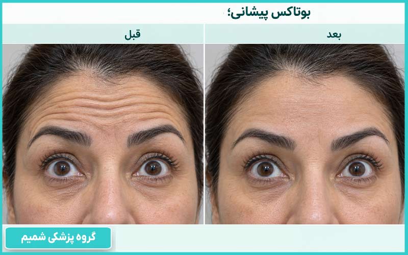 مقایسه خطوط پیشانی قبل و بعد از تزریق بوتاکس