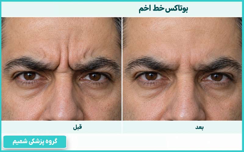 مقایسه خط اخم قبل و بعد از تزریق بوتاکس