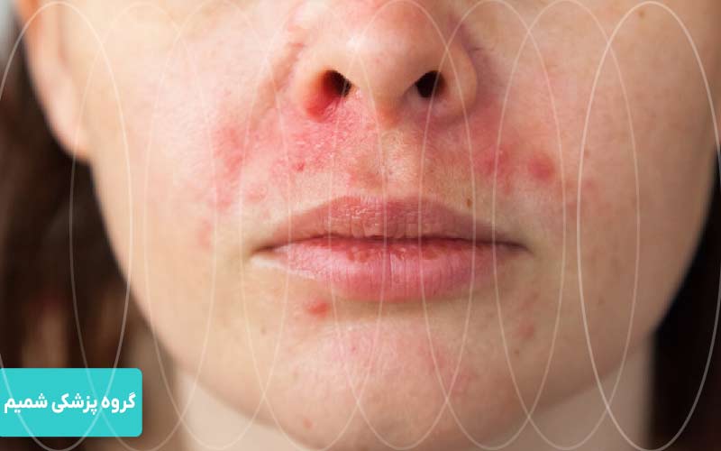 ممنوعیت لک، سوختگی، تبخال یا جوش فعال در لیزر موهای زائد در کرج 