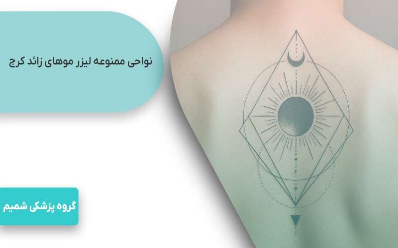 لیزر موهای زائد در کرج با motus ax 5 نواحی ممنوعه لیزر موهای زائد کرج