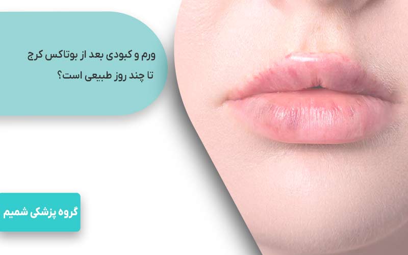 ورم و کبودی بعد از بوتاکس کرج