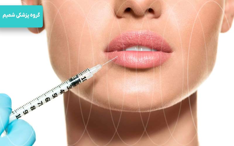 بوتاکس لب و دور لب کرج