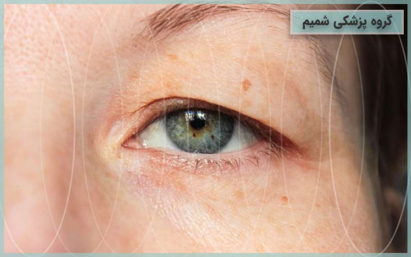 افتادگی پلک چه زمانی جلو دید را میگیرد؟