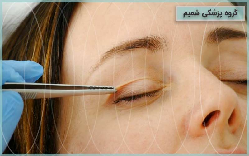 جراحی پلک در کرج 