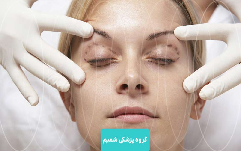 بلفاروپلاستی در عظیمیه کرج 4 مشاوره و بررسی فرم چشم قبل از عمل