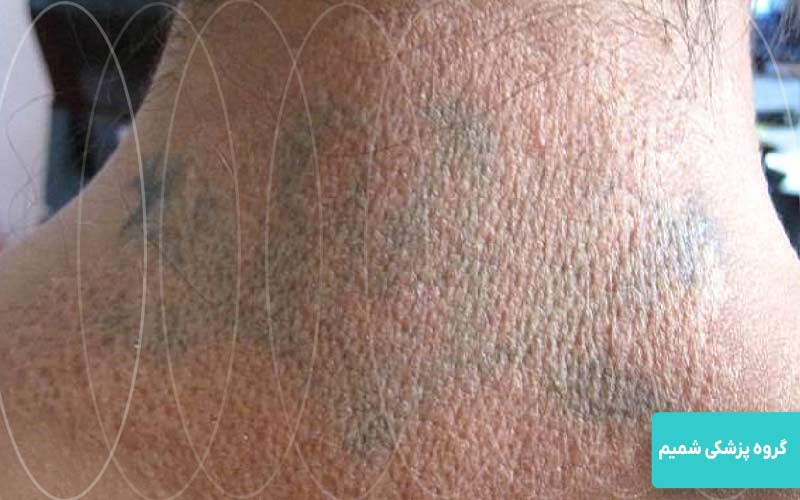 لیزر موهای زائد در جهانشهر کرج 8 تتو، زخم، التهاب یا تبخال فعال؛ چه زمانی لیزر خطرناک میشود؟