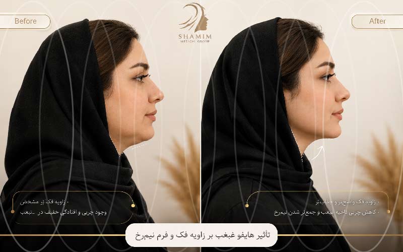 تاثیر هایفو غبغب بر زاویه فک و فرم نیم‌رخ