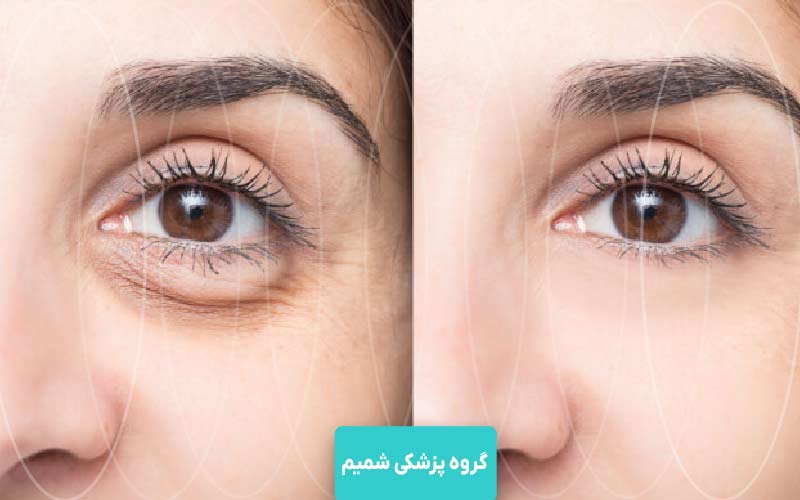 بلفاروپلاستی در عظیمیه کرج 3 بلفاروپلاستی پلک بالا و پلک پایین چه تفاوتی دارند؟