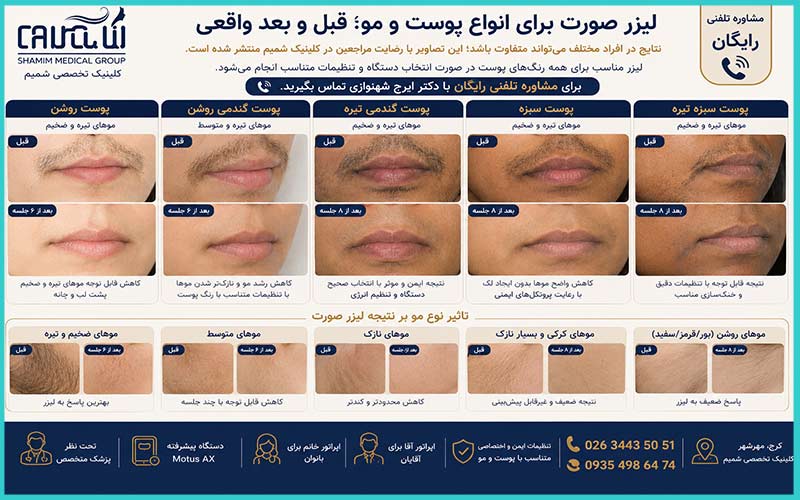 لیزر صورت برای کدام نوع پوست و مو نتیجه بهتری دارد؟