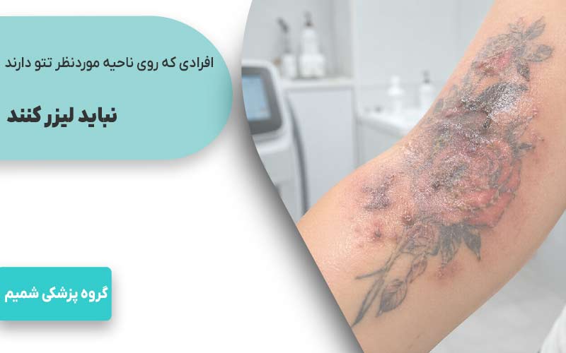 افرادی که روی ناحیه موردنظر تتو دارند