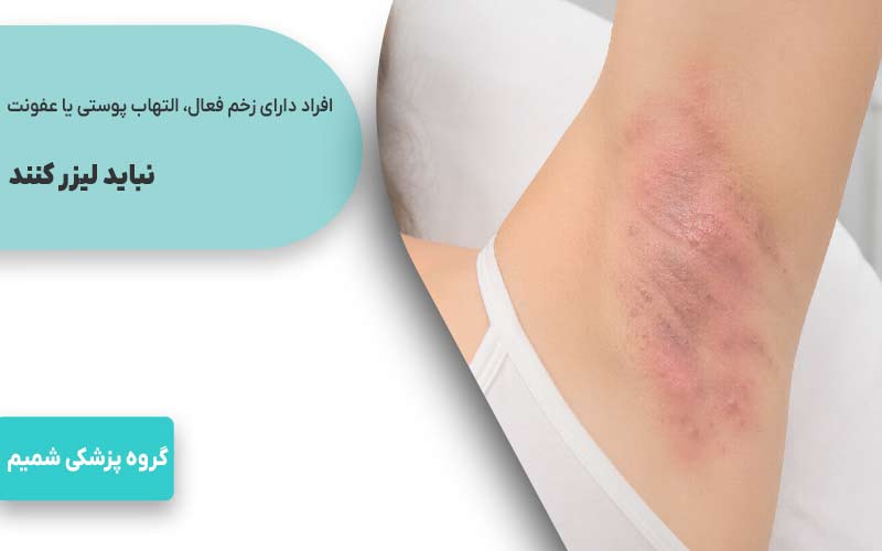 افراد دارای زخم فعال، التهاب پوستی یا عفونت در ناحیه لیزر