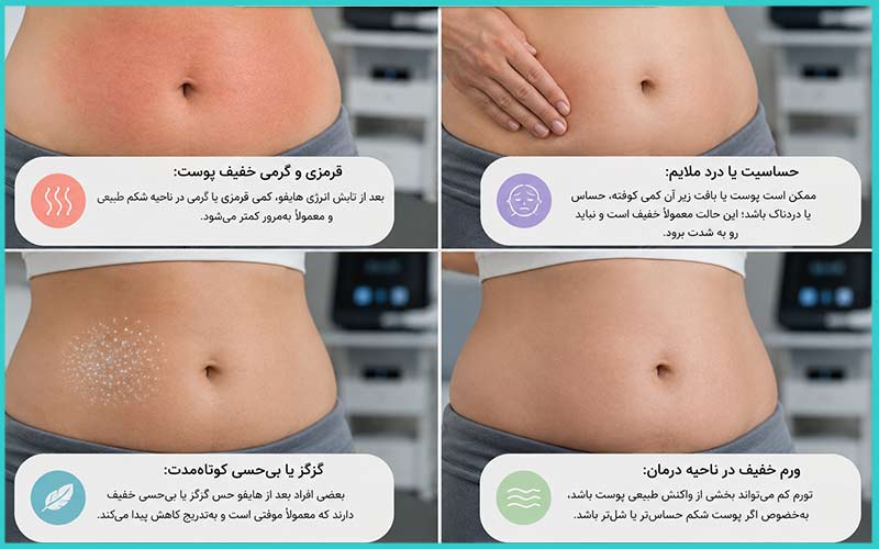 هایفو شکم در کرج|لیفت شکم بدون جراحی، با هزینهای منطقیتر 5 واکنشهای طبیعی پوست بعد از هایفو شکم در کرج