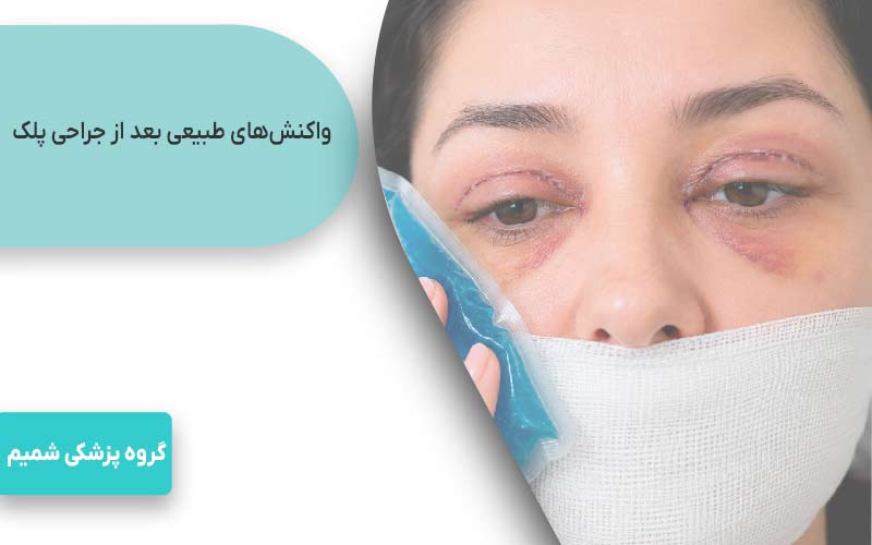 بلفاروپلاستی در جهانشهر کرج 5 واکنشهای طبیعی بعد از جراحی پلک