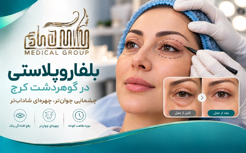 بلفاروپلاستی در گوهردشت کرج