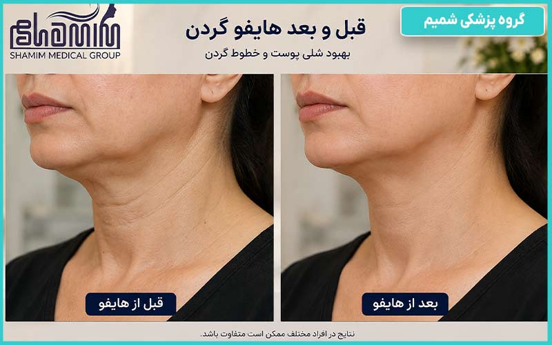 تاثیر هایفو بر شلی پوست و خطوط گردن