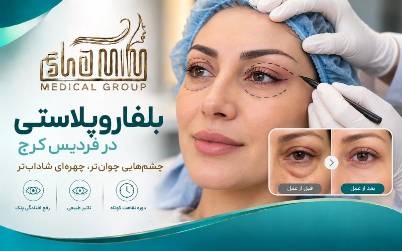 بلفاروپلاستی در فردیس کرج